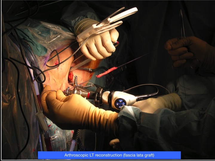 Figure 4 for case ligamentum teres of femoral head ( RID2653 )